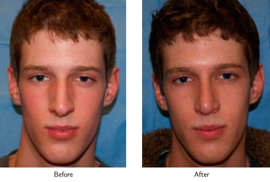 Rhinoplasty Before & After Gallery - Patient 64081027 - Image 1