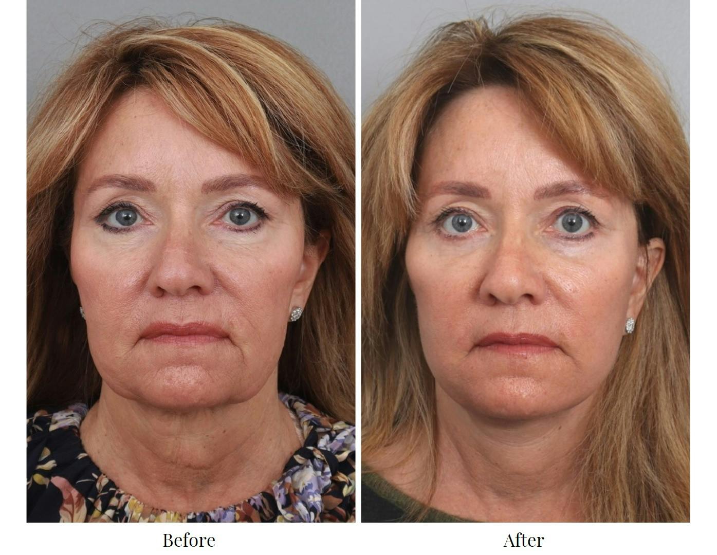 Facelift Before & After Gallery - Patient 64081030 - Image 2
