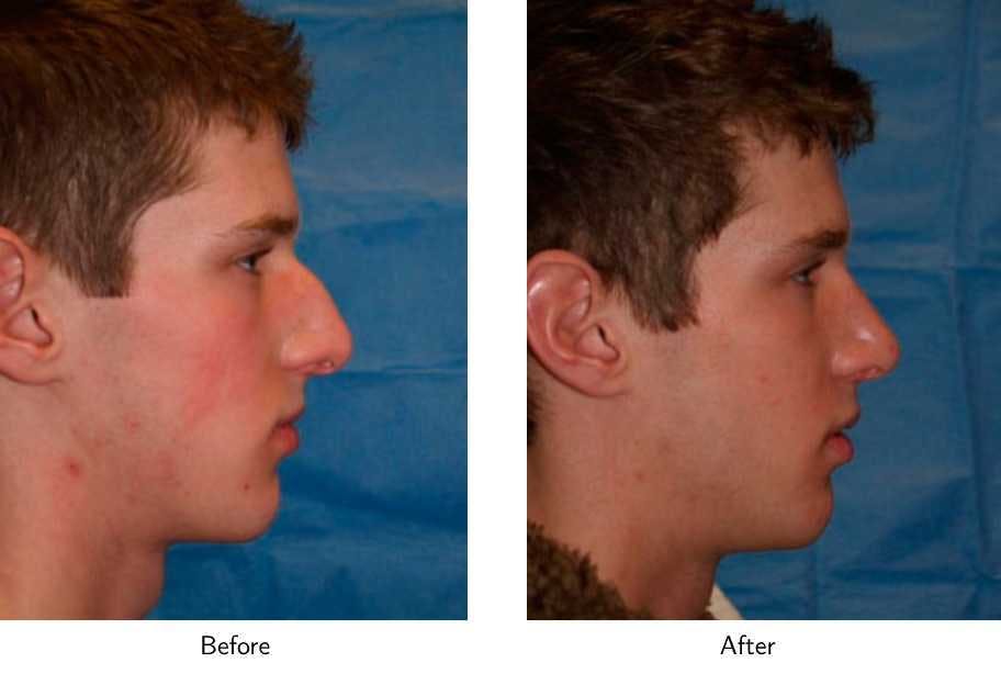 Rhinoplasty Before & After Gallery - Patient 64081027 - Image 2