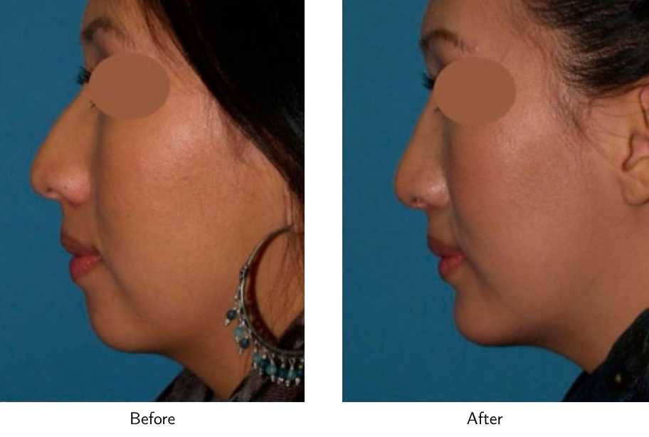 Rhinoplasty Before & After Gallery - Patient 64081029 - Image 2