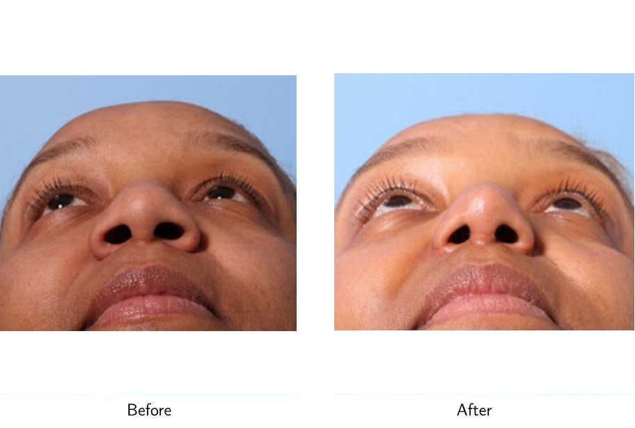 Rhinoplasty Before & After Gallery - Patient 64081031 - Image 2
