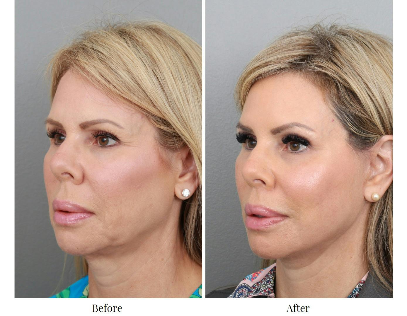 Facelift Before & After Gallery - Patient 64081058 - Image 4