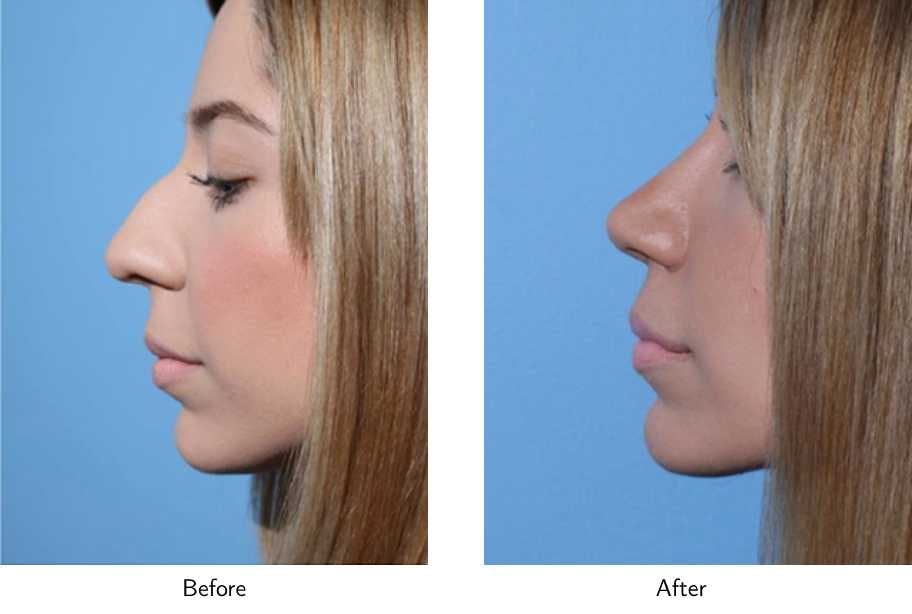 Rhinoplasty Before & After Gallery - Patient 64081032 - Image 1