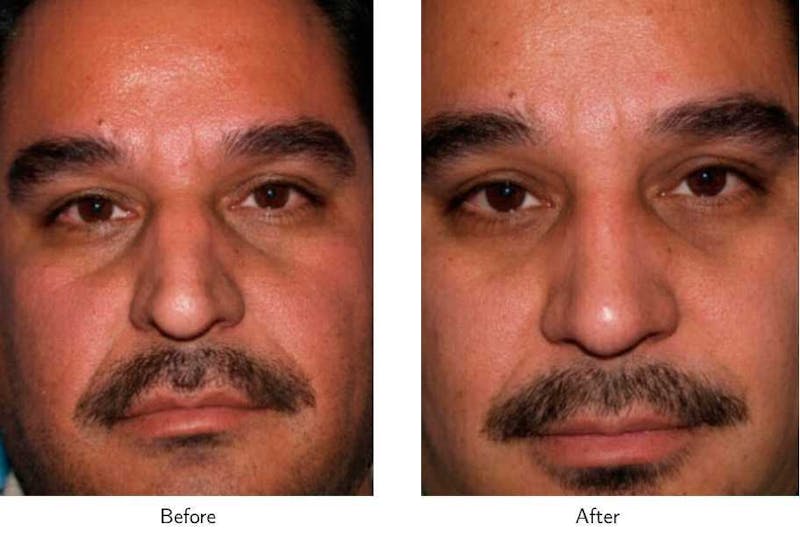 Rhinoplasty Before & After Gallery - Patient 64081033 - Image 1