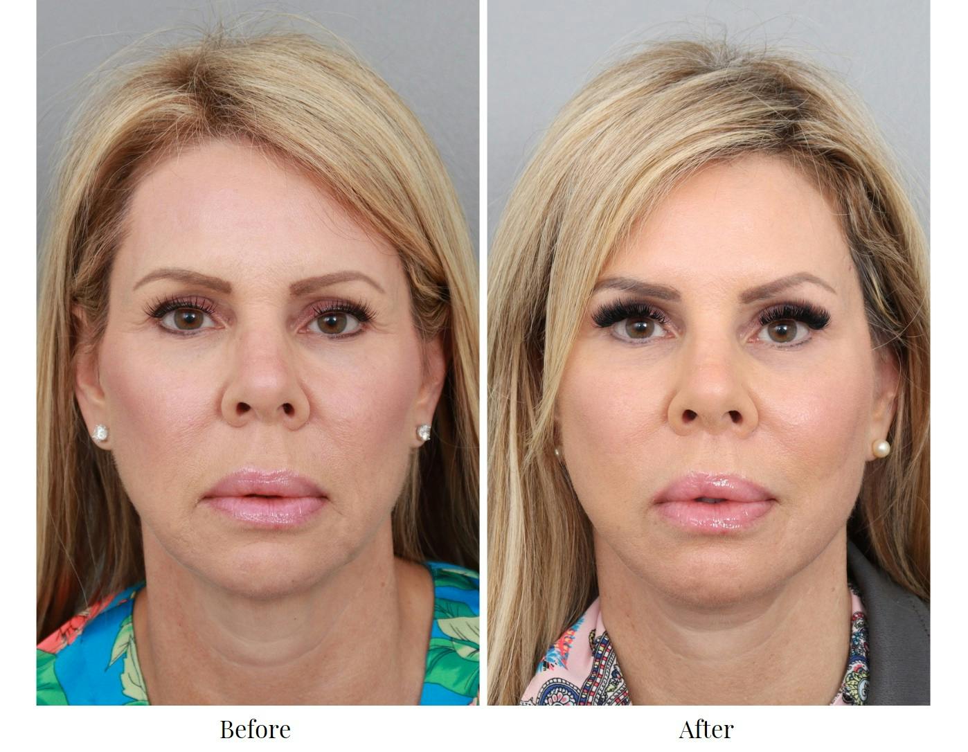 Facelift Before & After Gallery - Patient 64081058 - Image 3