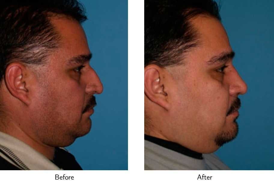 Rhinoplasty Before & After Gallery - Patient 64081033 - Image 2
