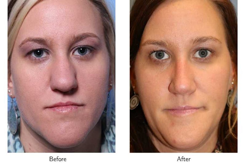 Rhinoplasty Before & After Gallery - Patient 64081037 - Image 1