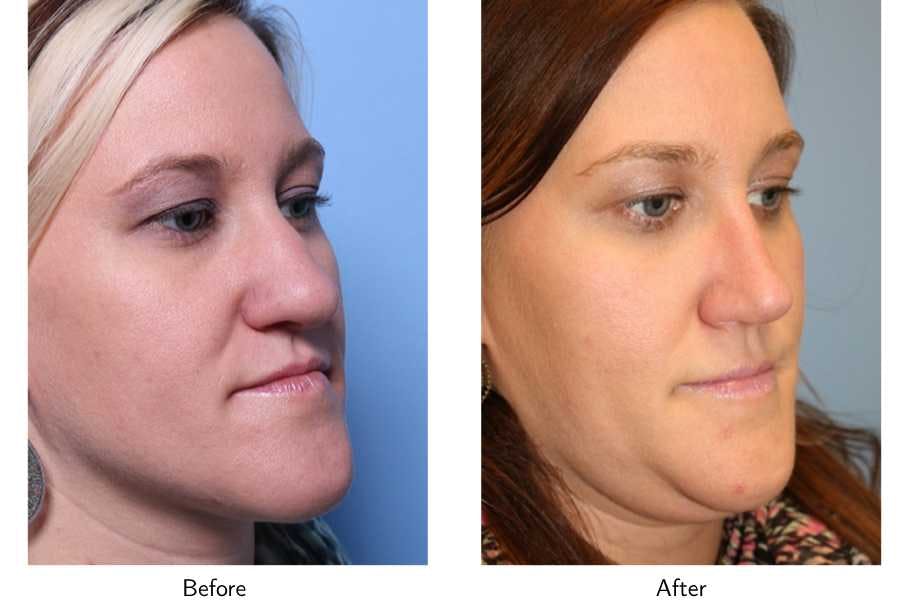 Rhinoplasty Before & After Gallery - Patient 64081037 - Image 2