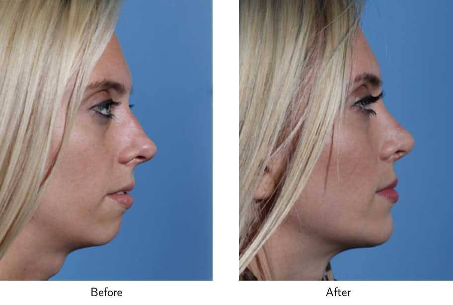 Rhinoplasty Before & After Gallery - Patient 64081038 - Image 1