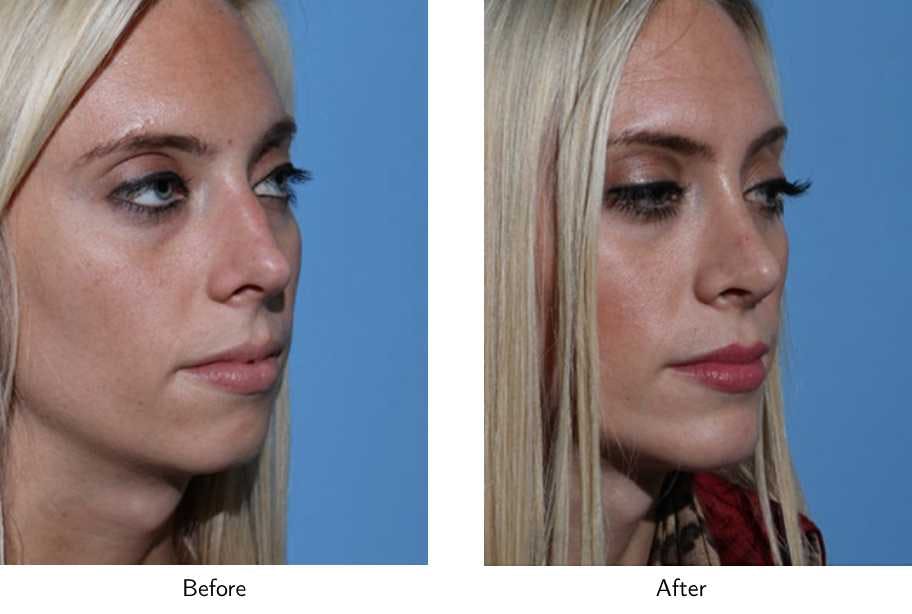 Rhinoplasty Before & After Gallery - Patient 64081038 - Image 2