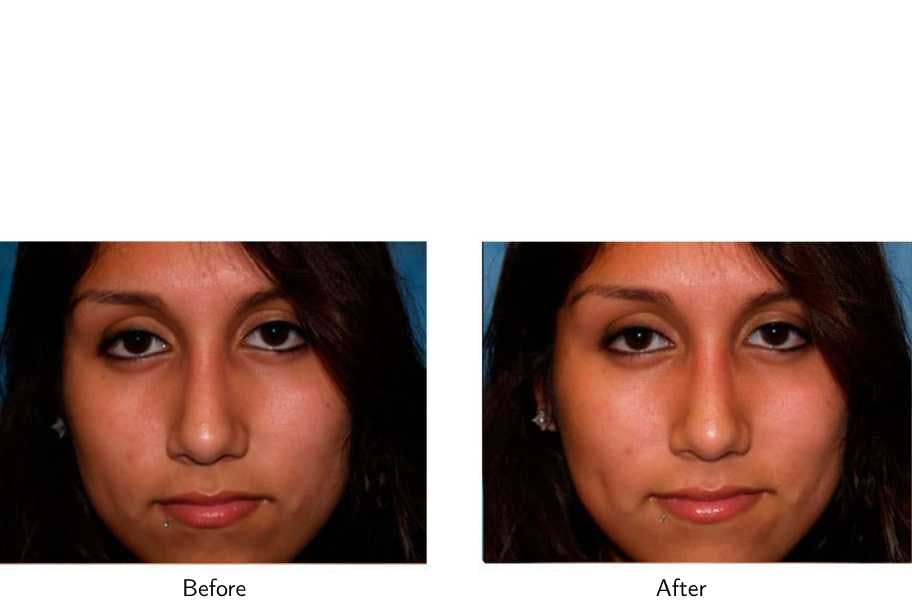 Rhinoplasty Before & After Gallery - Patient 64081039 - Image 3