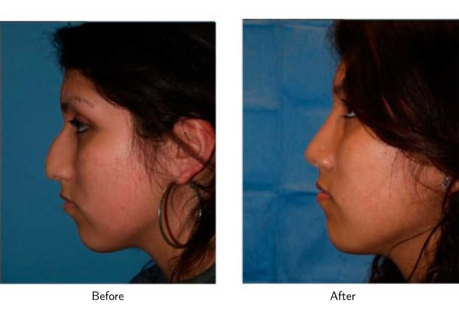 Rhinoplasty Before & After Gallery - Patient 64081039 - Image 2