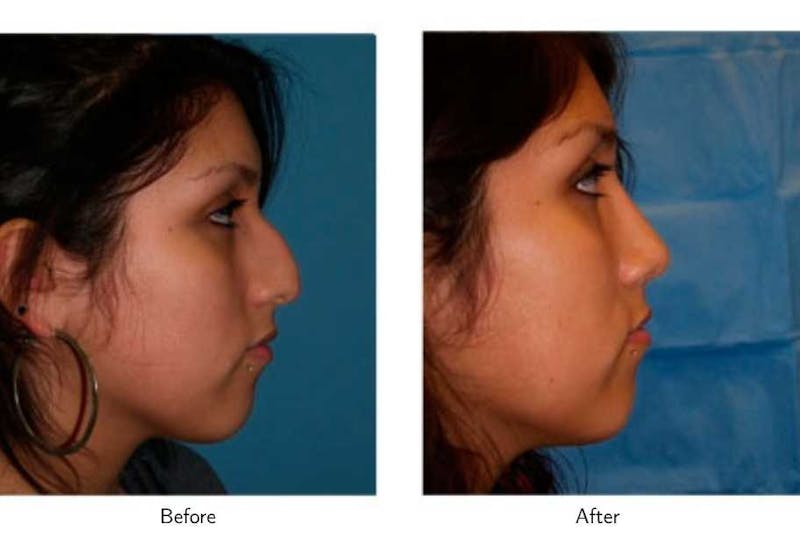 Rhinoplasty Before & After Gallery - Patient 64081039 - Image 1