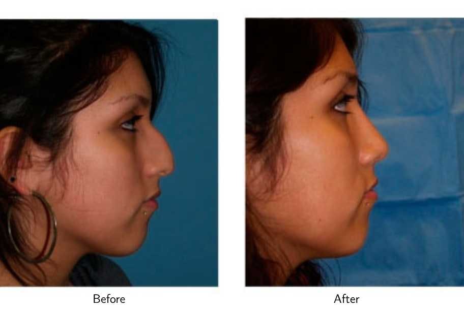 Rhinoplasty Before & After Gallery - Patient 64081039 - Image 1