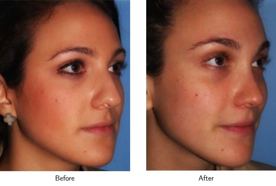 Rhinoplasty Before & After Gallery - Patient 64081041 - Image 1