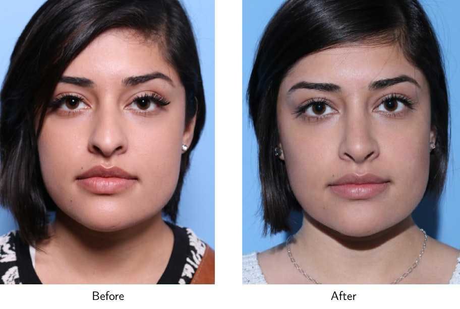 Rhinoplasty Before & After Gallery - Patient 64081042 - Image 1