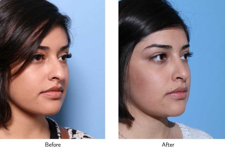 Rhinoplasty Before & After Gallery - Patient 64081042 - Image 3