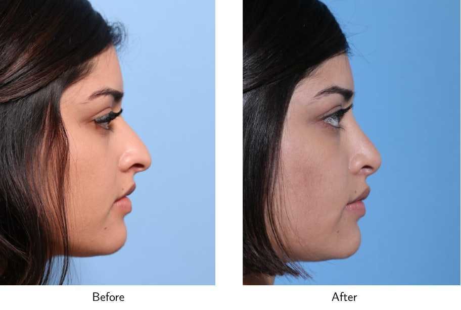 Rhinoplasty Before & After Gallery - Patient 64081042 - Image 2