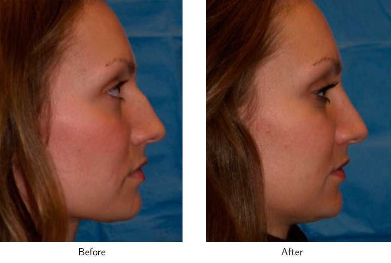 Rhinoplasty Before & After Gallery - Patient 64081043 - Image 1