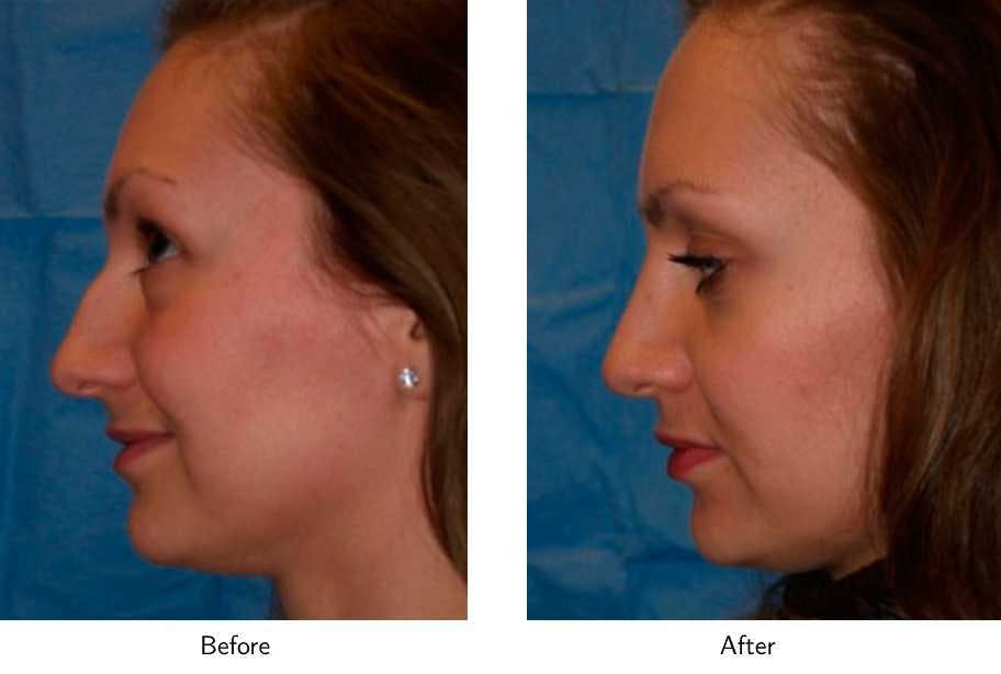 Rhinoplasty Before & After Gallery - Patient 64081043 - Image 2