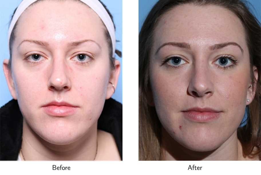 Rhinoplasty Before & After Gallery - Patient 64081044 - Image 2