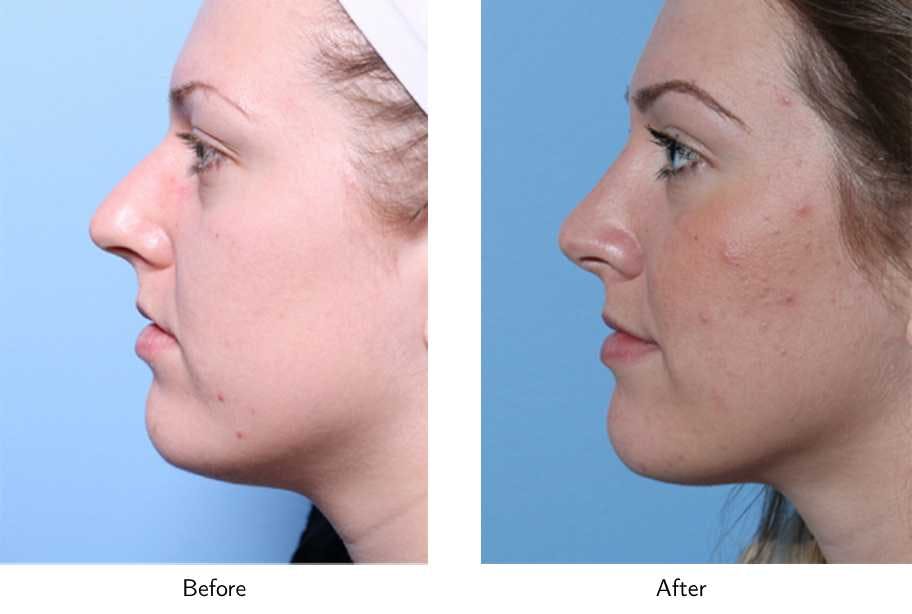 Rhinoplasty Before & After Gallery - Patient 64081044 - Image 1