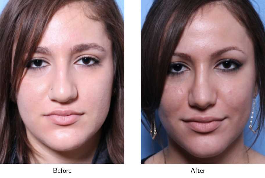 Rhinoplasty Before & After Gallery - Patient 64081046 - Image 2