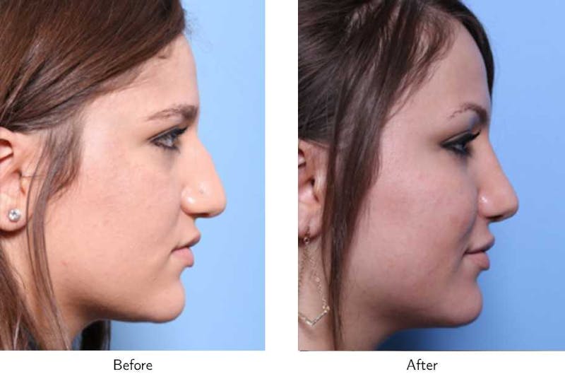 Rhinoplasty Before & After Gallery - Patient 64081046 - Image 1