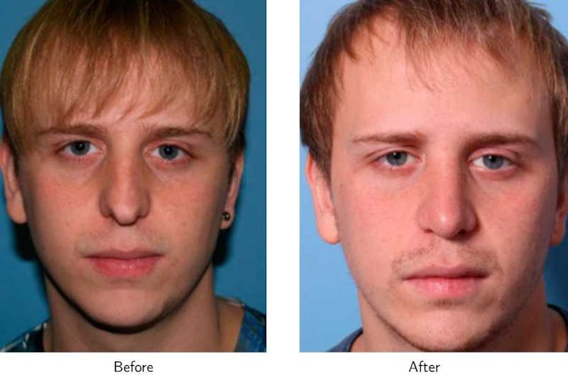 Rhinoplasty Before & After Gallery - Patient 64081047 - Image 1