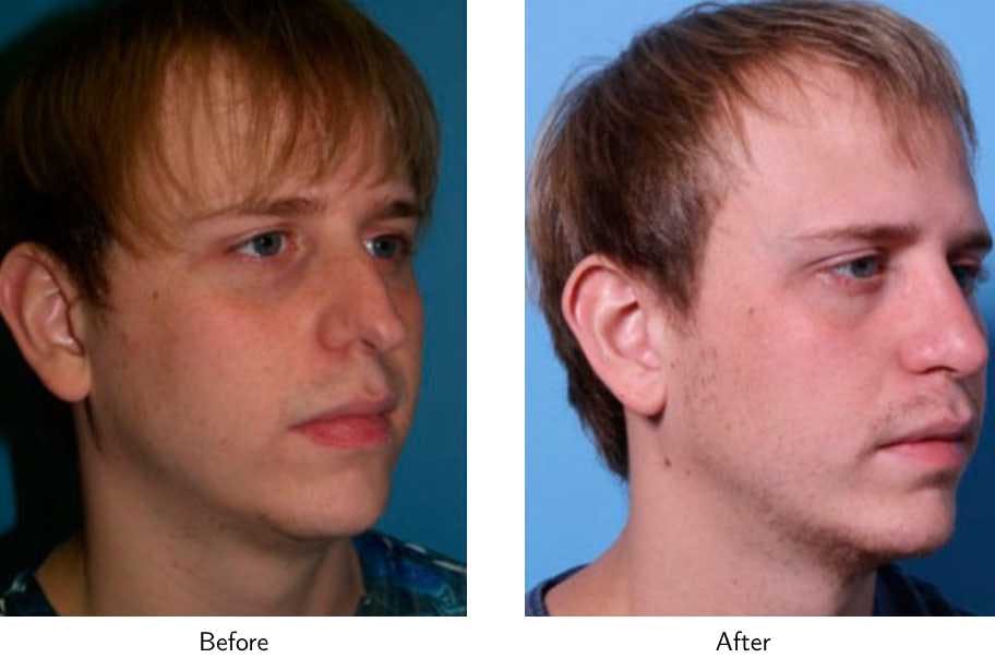 Rhinoplasty Before & After Gallery - Patient 64081047 - Image 3