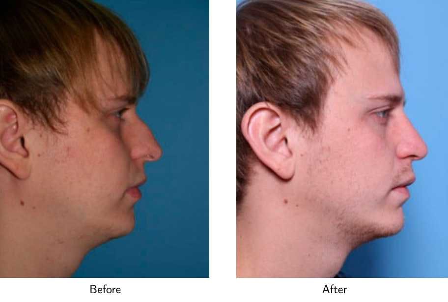 Rhinoplasty Before & After Gallery - Patient 64081047 - Image 2