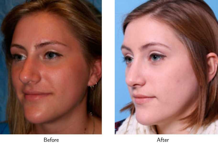 Rhinoplasty Before & After Gallery - Patient 64081048 - Image 1