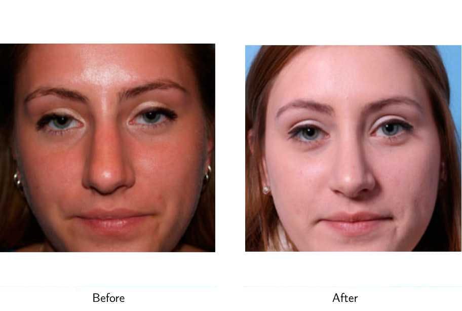 Rhinoplasty Before & After Gallery - Patient 64081048 - Image 3