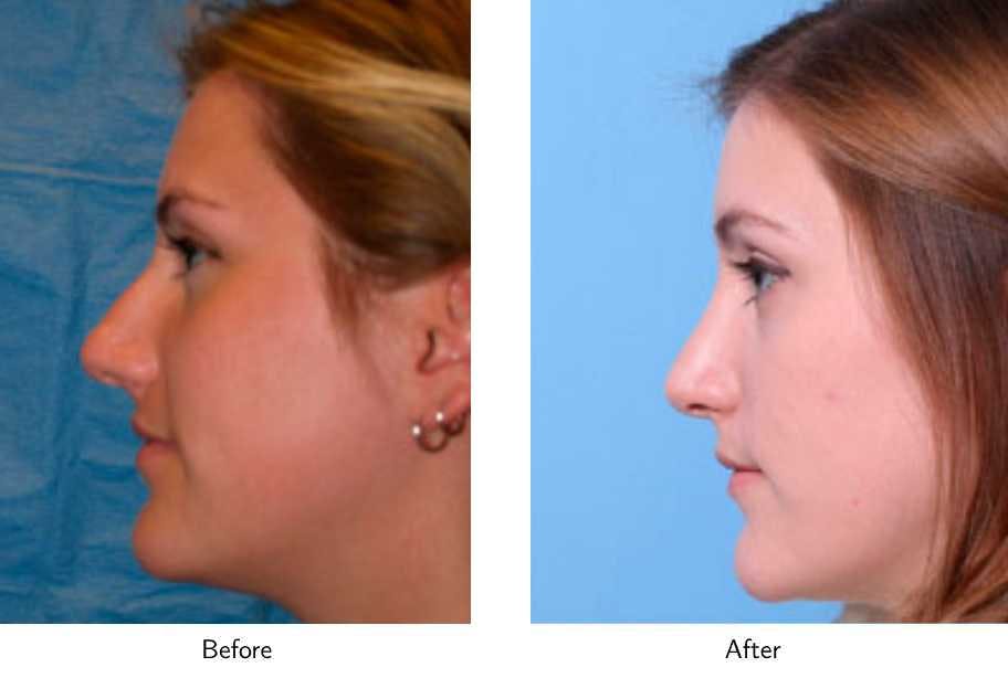 Rhinoplasty Before & After Gallery - Patient 64081048 - Image 2