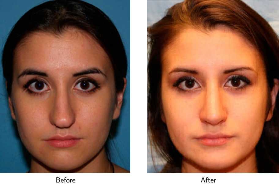 Rhinoplasty Before & After Gallery - Patient 64081049 - Image 1
