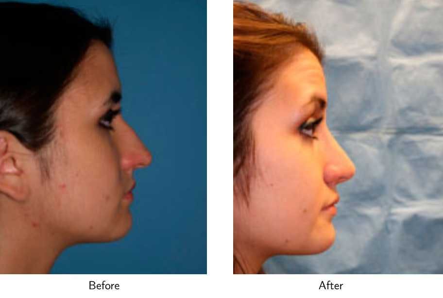 Rhinoplasty Before & After Gallery - Patient 64081049 - Image 2