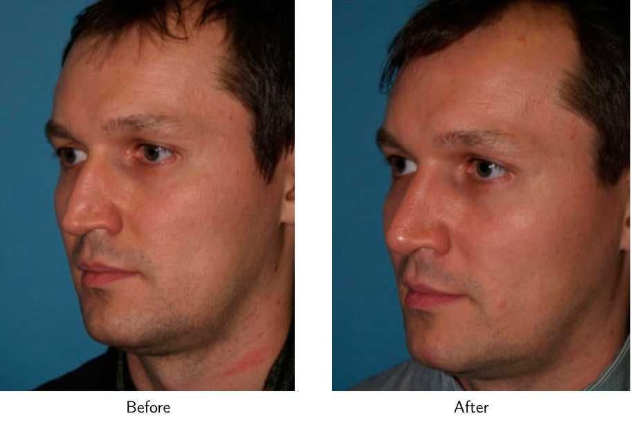 Rhinoplasty Before & After Gallery - Patient 64081050 - Image 4
