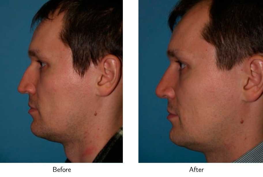 Rhinoplasty Before & After Gallery - Patient 64081050 - Image 2