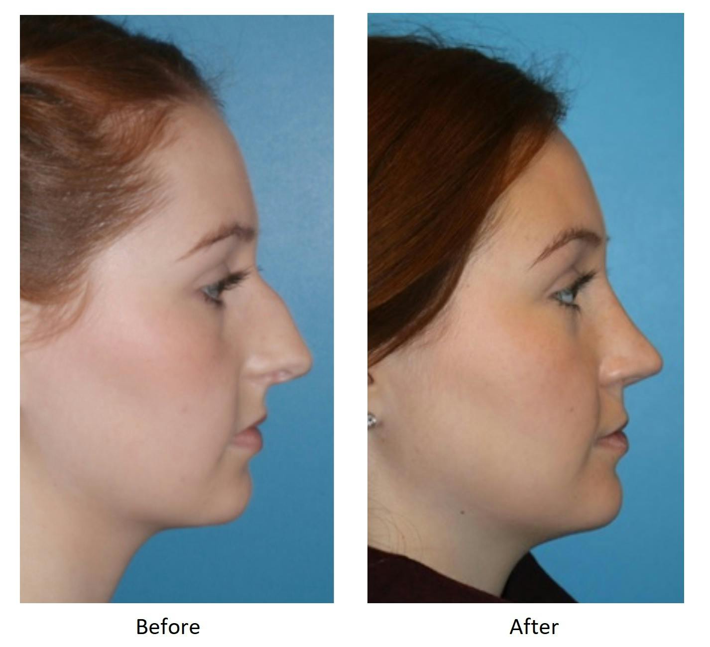 Rhinoplasty Before & After Gallery - Patient 64081052 - Image 1