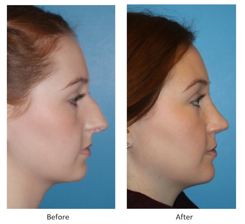 Rhinoplasty Before & After Gallery - Patient 64081052 - Image 1