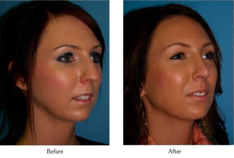Rhinoplasty Before & After Gallery - Patient 64081053 - Image 1