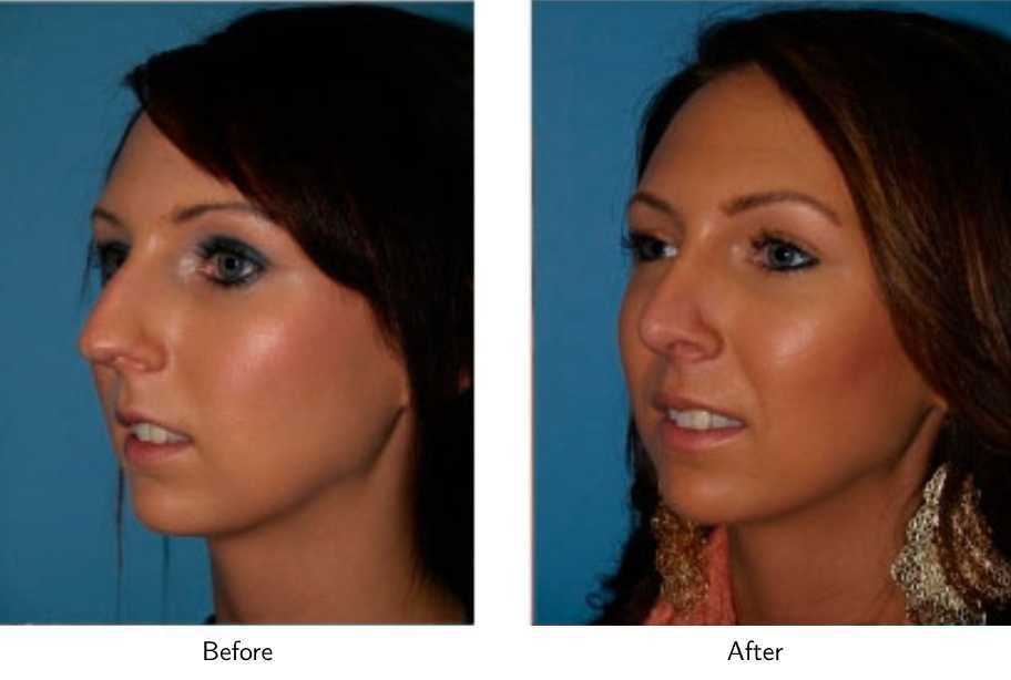 Rhinoplasty Before & After Gallery - Patient 64081053 - Image 2