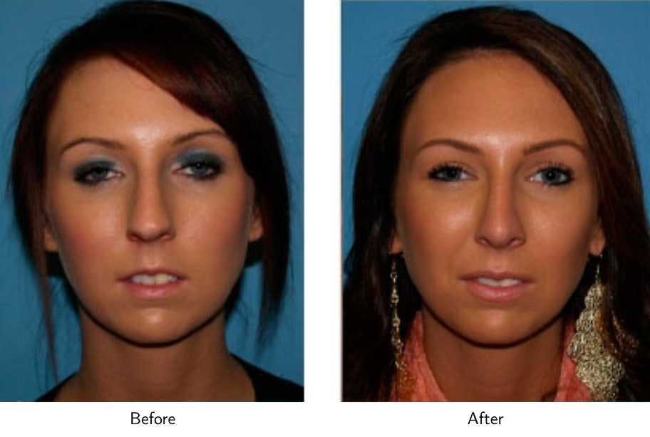 Rhinoplasty Before & After Gallery - Patient 64081053 - Image 3