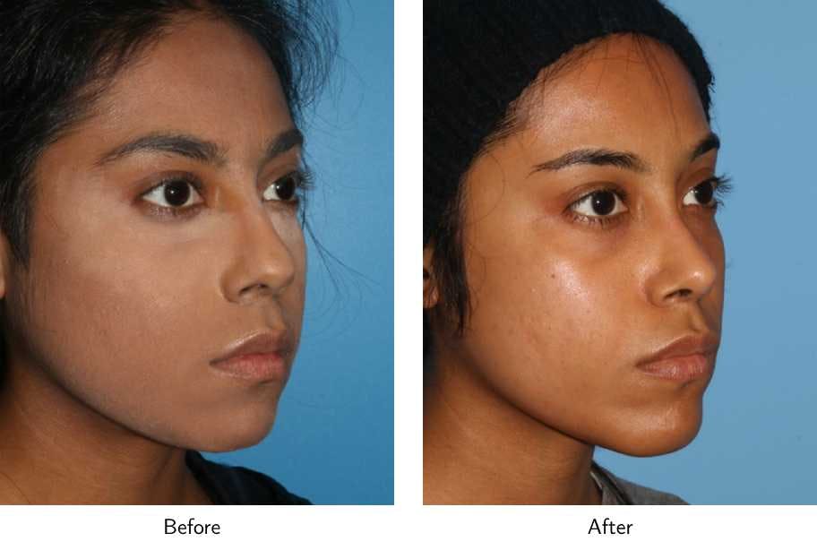 Rhinoplasty Before & After Gallery - Patient 64081070 - Image 2