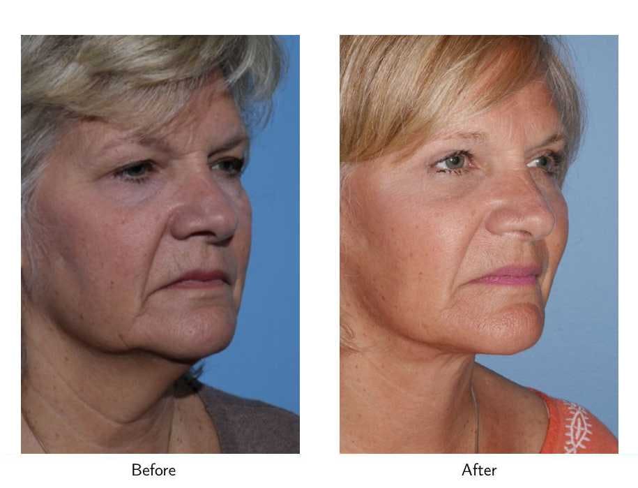Facelift Before & After Gallery - Patient 64081059 - Image 1