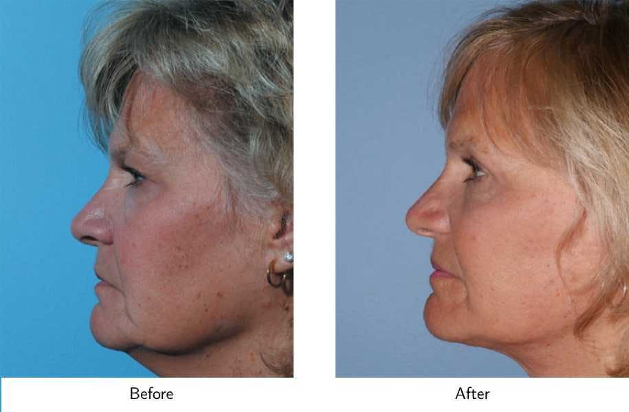 Facelift Before & After Gallery - Patient 64081059 - Image 3