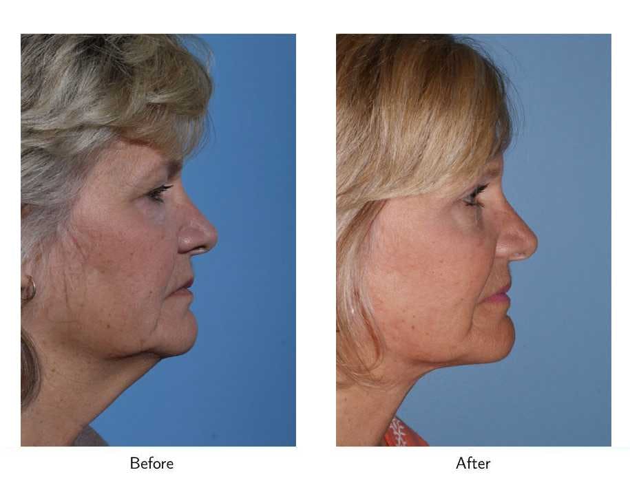 Facelift Before & After Gallery - Patient 64081059 - Image 2
