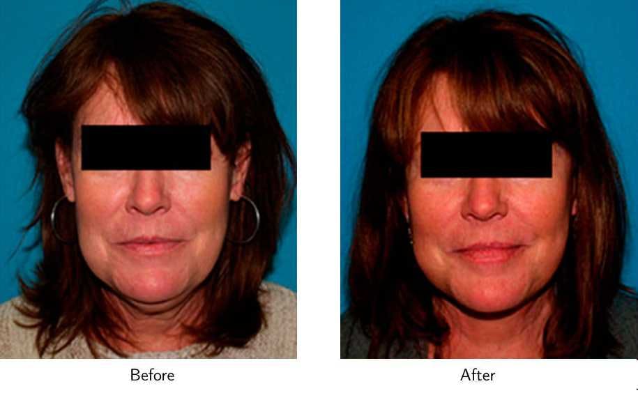 Facelift Before & After Gallery - Patient 64081060 - Image 3