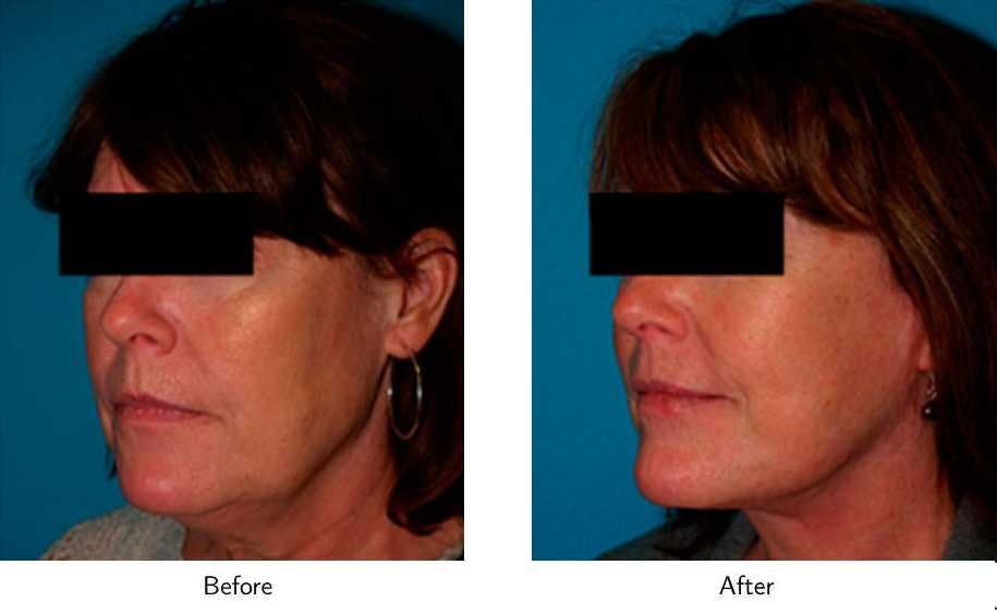 Facelift Before & After Gallery - Patient 64081060 - Image 4