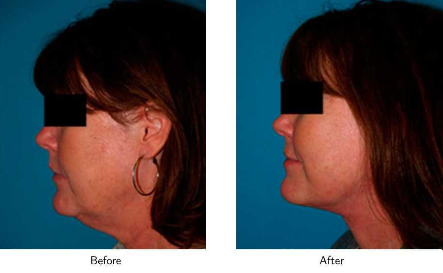 Facelift Before & After Gallery - Patient 64081060 - Image 2